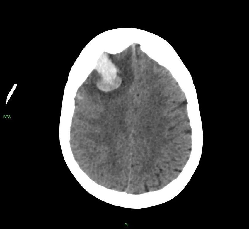 Cerebral amyloid angiopathy-associated lobar intracerebral hemorrhage (Radiopaedia 58569-65734 Axial non-contrast 23).jpg