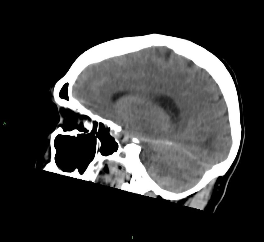 Cerebral amyloid angiopathy-associated lobar intracerebral hemorrhage (Radiopaedia 58756-65977 C 36).jpg