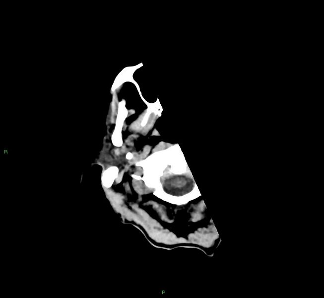 File:Cerebral amyloid angiopathy-associated lobar intracerebral hemorrhage (Radiopaedia 58758-65980 Axial non-contrast 49).jpg