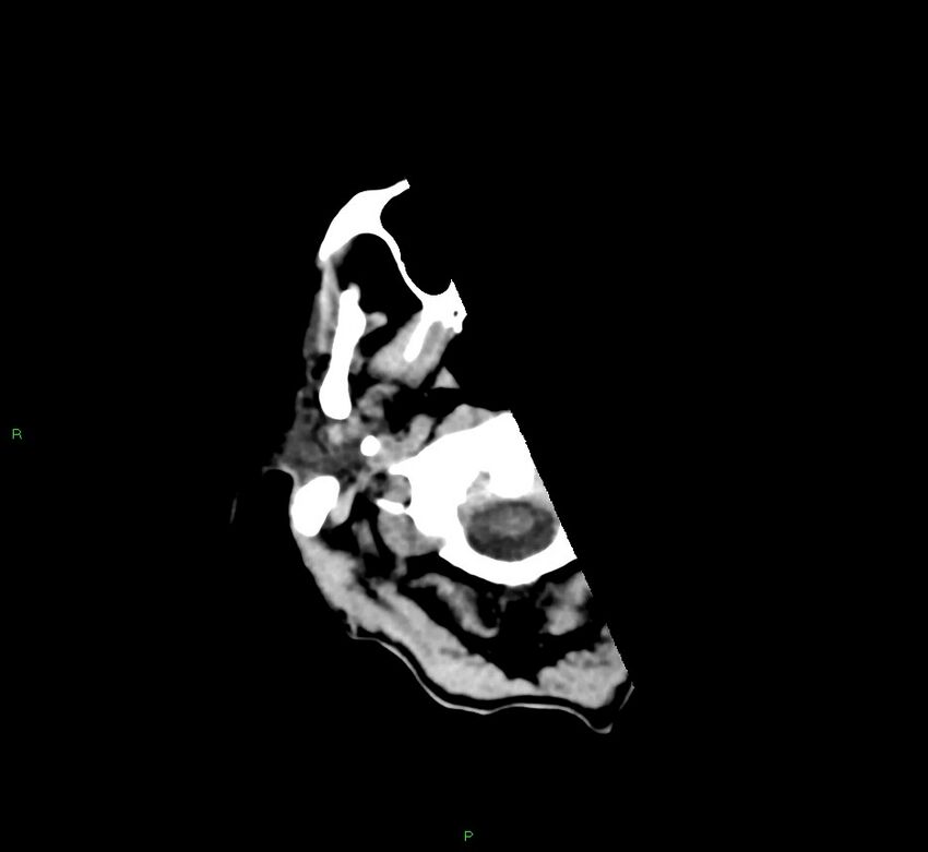 Cerebral amyloid angiopathy-associated lobar intracerebral hemorrhage (Radiopaedia 58758-65980 Axial non-contrast 49).jpg