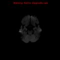Cerebral and orbital tuberculomas (Radiopaedia 13308-13311 Axial DWI 8).jpg