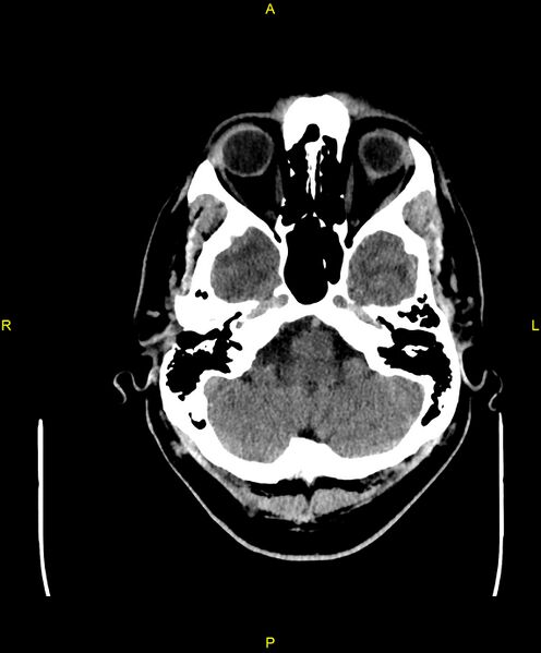 File:Cerebral autosomal dominant arteriopathy with subcortical infarcts and leukoencephalopathy (CADASIL) (Radiopaedia 86108-102051 Axial non-contrast 18).jpg
