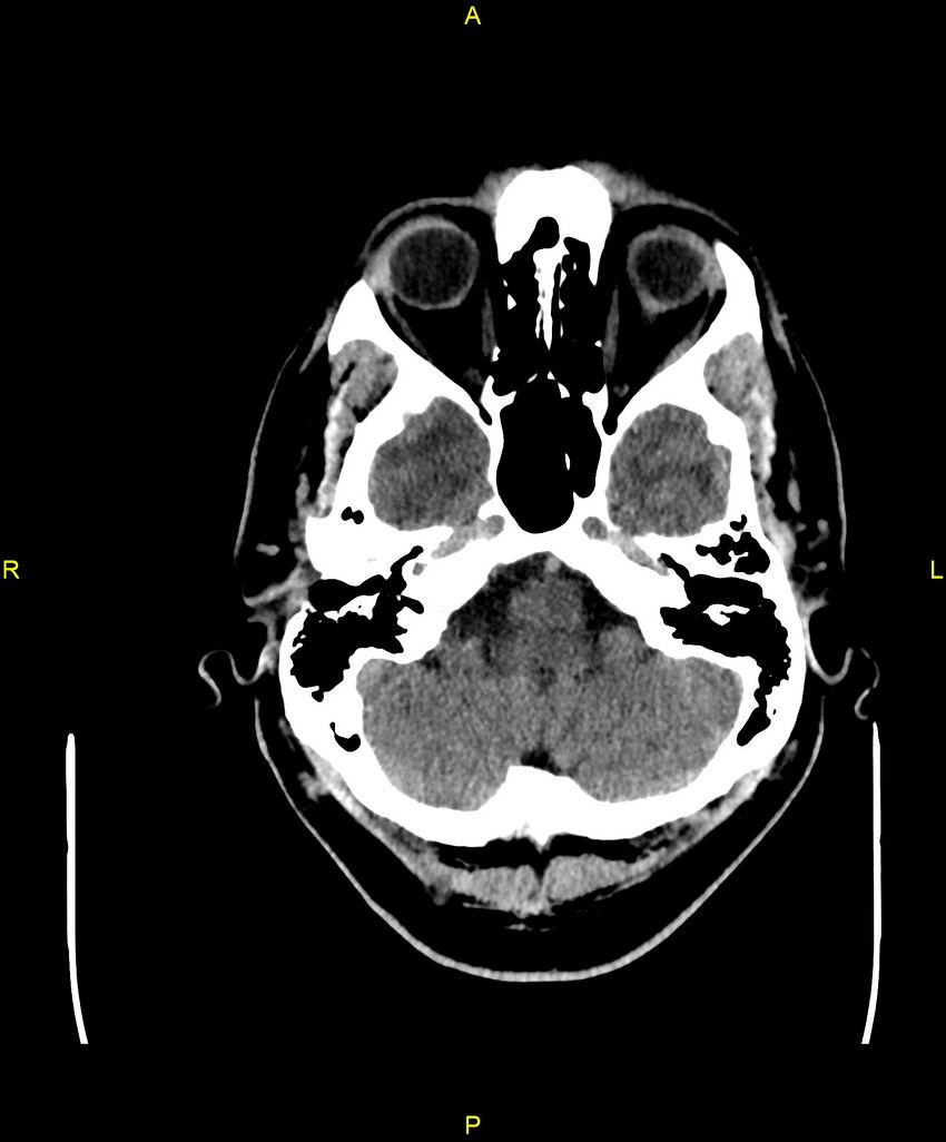 Cerebral autosomal dominant arteriopathy with subcortical infarcts and leukoencephalopathy (CADASIL) (Radiopaedia 86108-102051 Axial non-contrast 18).jpg