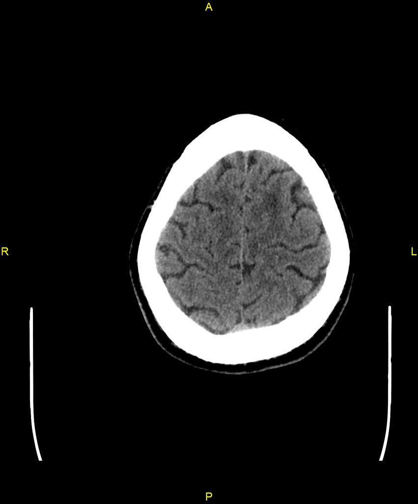 Cerebral autosomal dominant arteriopathy with subcortical infarcts and leukoencephalopathy (CADASIL) (Radiopaedia 86108-102051 Axial non-contrast 96).jpg
