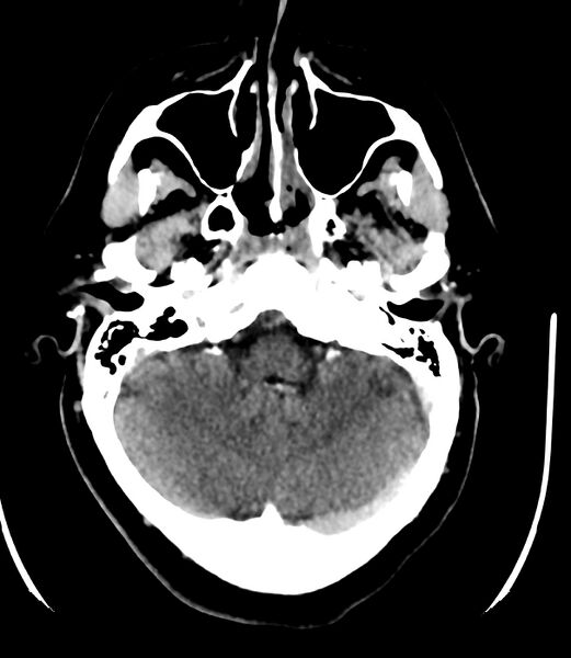 File:Cerebral dural venous sinus thrombosis (Radiopaedia 86514-102575 Axial non-contrast 10).jpg
