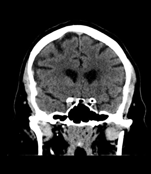 File:Cerebral dural venous sinus thrombosis (Radiopaedia 86514-102575 Coronal non-contrast 16).jpg