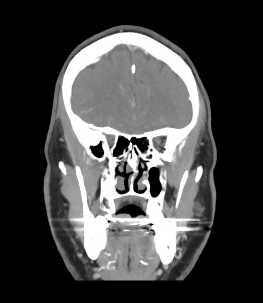 File:Cerebral dural venous sinus thrombosis (Radiopaedia 86514-102576 B 14).jpg