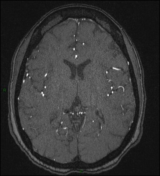 File:Cerebral fat embolism (Radiopaedia 35022-36525 Axial TOF 113).jpg