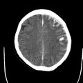 Cerebral hemorrhagic contusions (Radiopaedia 23145-23188 Axial non-contrast 28).jpg