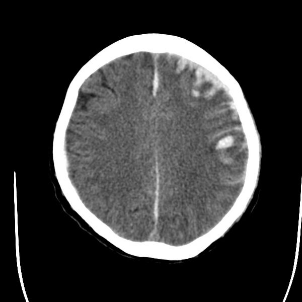 File:Cerebral hemorrhagic contusions (Radiopaedia 23145-23188 Axial non-contrast 28).jpg