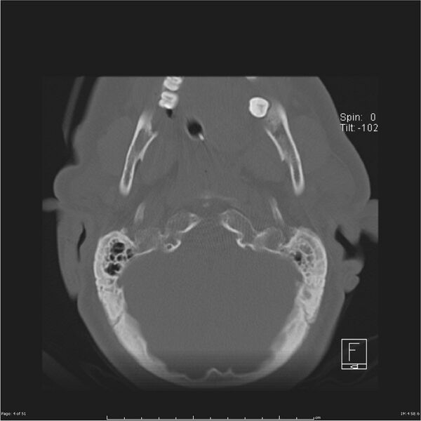 File:Cerebral hemorrhagic contusions and cervical spine fractures (Radiopaedia 32865-33841 C 4).jpg