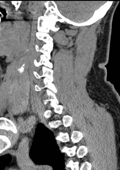 File:Cerebral hemorrhagic contusions and cervical spine fractures (Radiopaedia 32865-33841 G 73).jpg