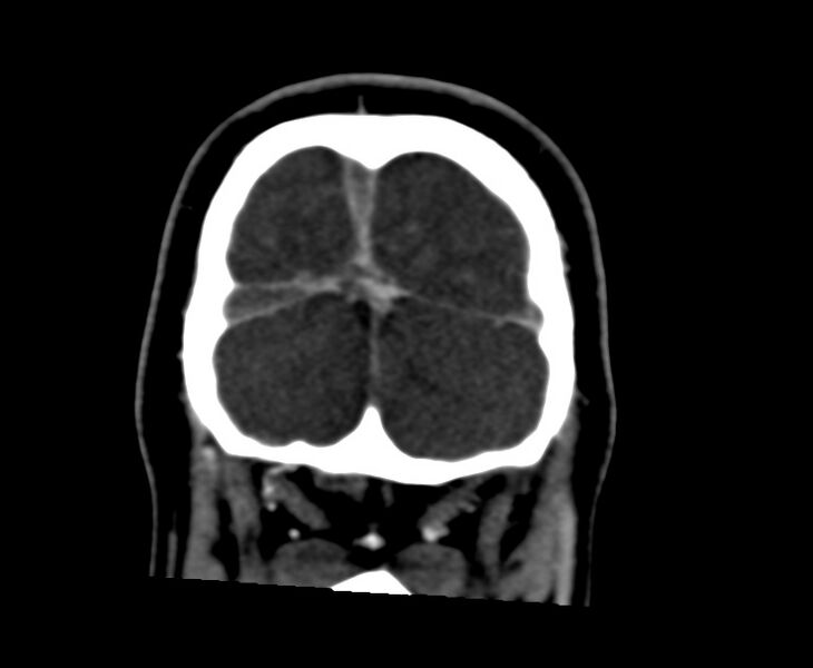 File:Cerebral venous sinus thrombosis (Radiopaedia 59224-66646 Coronal C+ delayed 70).jpg