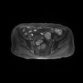 Cervical carcinoma (Radiopaedia 78847-91705 Axial T1 fat sat 5).jpg