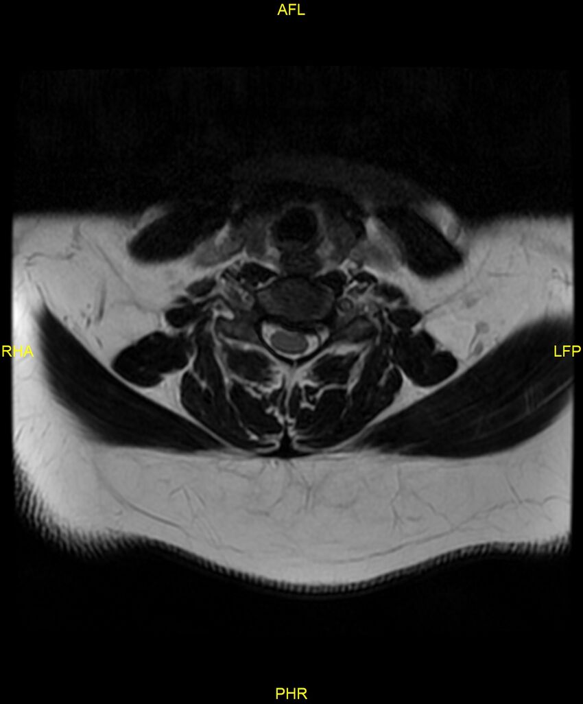 Cervical disc protrusion (Radiopaedia 87147-103415 Axial T2 40).jpg