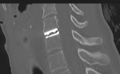 Cervical disc replacement (Radiopaedia 37383-39205 Sagittal bone window 42).png
