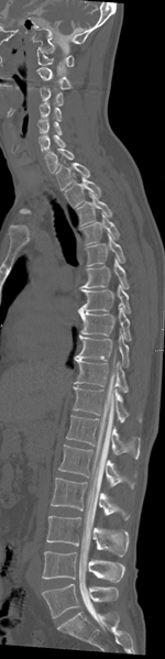 File:Cervical dural CSF leak on MRI and CT treated by blood patch (Radiopaedia 49748-54996 A 13).png