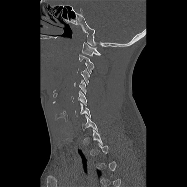 File:Cervical facet fracture and anterior discoligamentous injury (Radiopaedia 32139-33083 Sagittal bone window 27).jpg