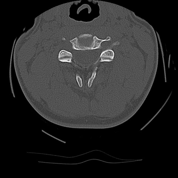 File:Cervical flexion teardrop fracture with cord hemorrhage (Radiopaedia 32497-33454 Axial bone window 31).jpg