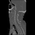 Cervical spine fractures with vertebral artery dissection (Radiopaedia 32135-33078 Sagittal bone window 17).jpg