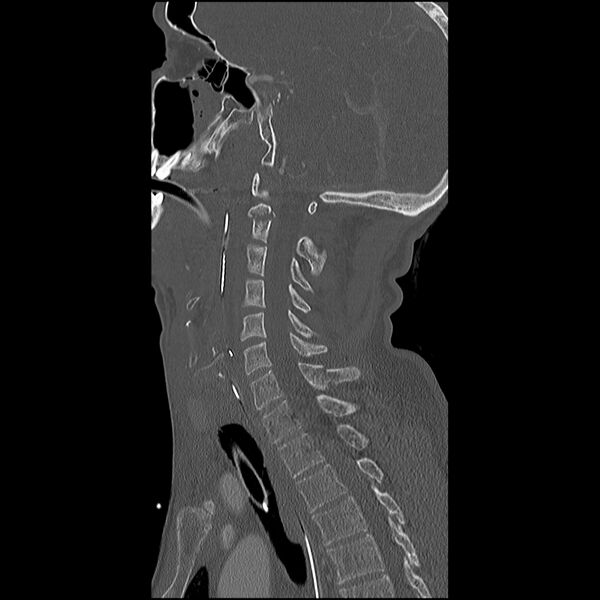 File:Cervical spine fractures with vertebral artery dissection (Radiopaedia 32135-33078 Sagittal bone window 17).jpg