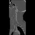 Cervical spine fractures with vertebral artery dissection (Radiopaedia 32135-33078 Sagittal bone window 31).jpg