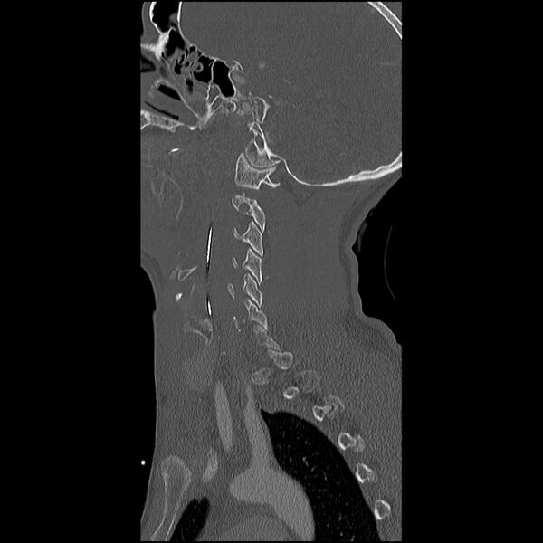 File:Cervical spine fractures with vertebral artery dissection (Radiopaedia 32135-33078 Sagittal bone window 31).jpg
