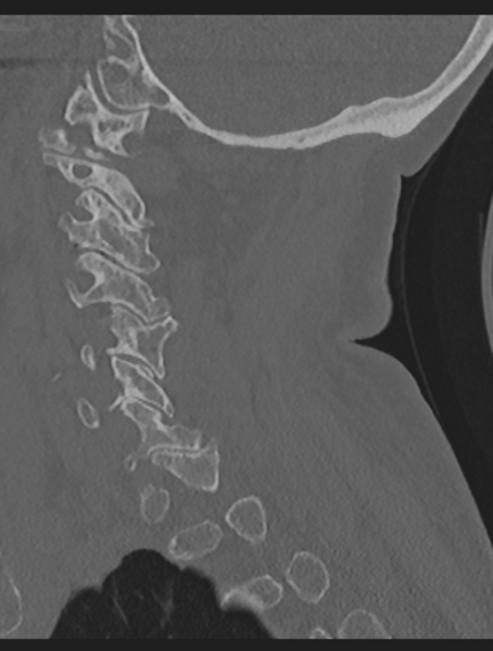 File:Cervical spondylolysis (Radiopaedia 49616-54811 Sagittal bone window 24).png