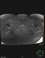 Cesarian scar endometriosis (Radiopaedia 68495-78066 Axial T1 C+ fat sat 25).jpg
