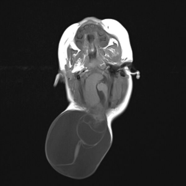 File:Chiari III malformation with occipital encephalocele (Radiopaedia 79446-92559 Axial T1 10).jpg