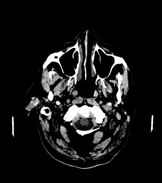 File:Cholangiocarcinoma with cerebral metastases (Radiopaedia 83519-98628 Axial non-contrast 9).jpg
