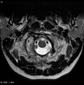 Chondroblastoma - occipital condyle (Radiopaedia 5569-7306 Axial T2 1).jpg