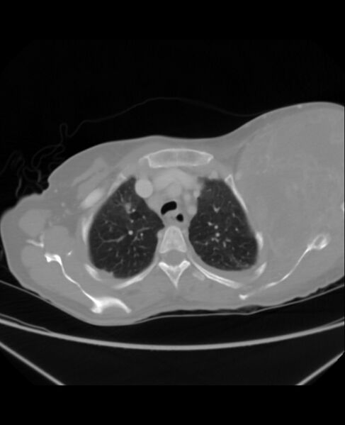 File:Chondrosarcoma (Radiopaedia 79427-92535 Axial lung window 11).jpg
