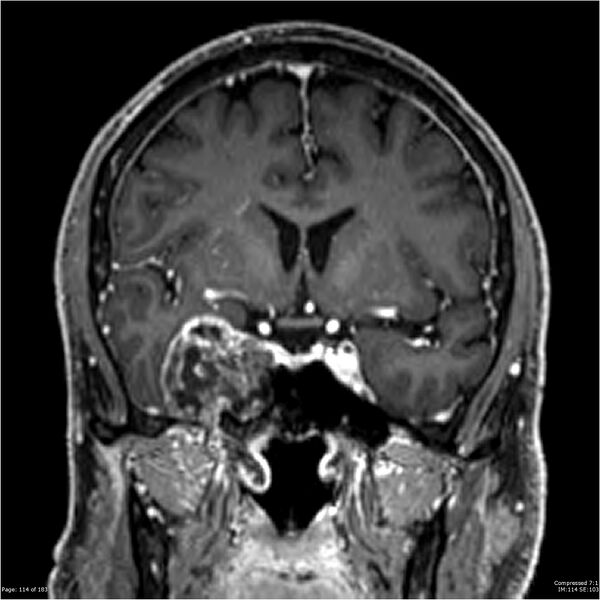 File:Chondrosarcoma of skull base- grade II (Radiopaedia 40948-43654 Coronal T1 C+ 25).jpg