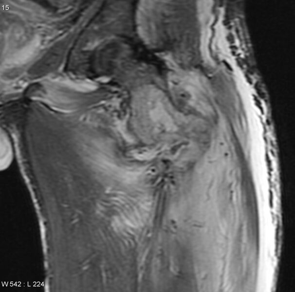 File:Chondrosarcoma with pathological fracture - femur (Radiopaedia 6174-7629 Coronal STIR 6).jpg