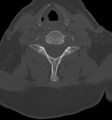 Chordoma (C4 vertebra) (Radiopaedia 47561-52188 Axial bone window 34).png