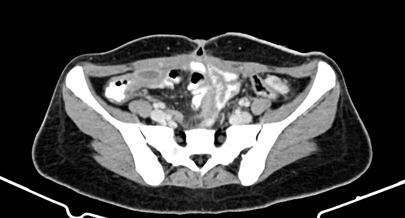 File:Choriocarcinoma liver metastases (Radiopaedia 74768-85766 A 156).jpg