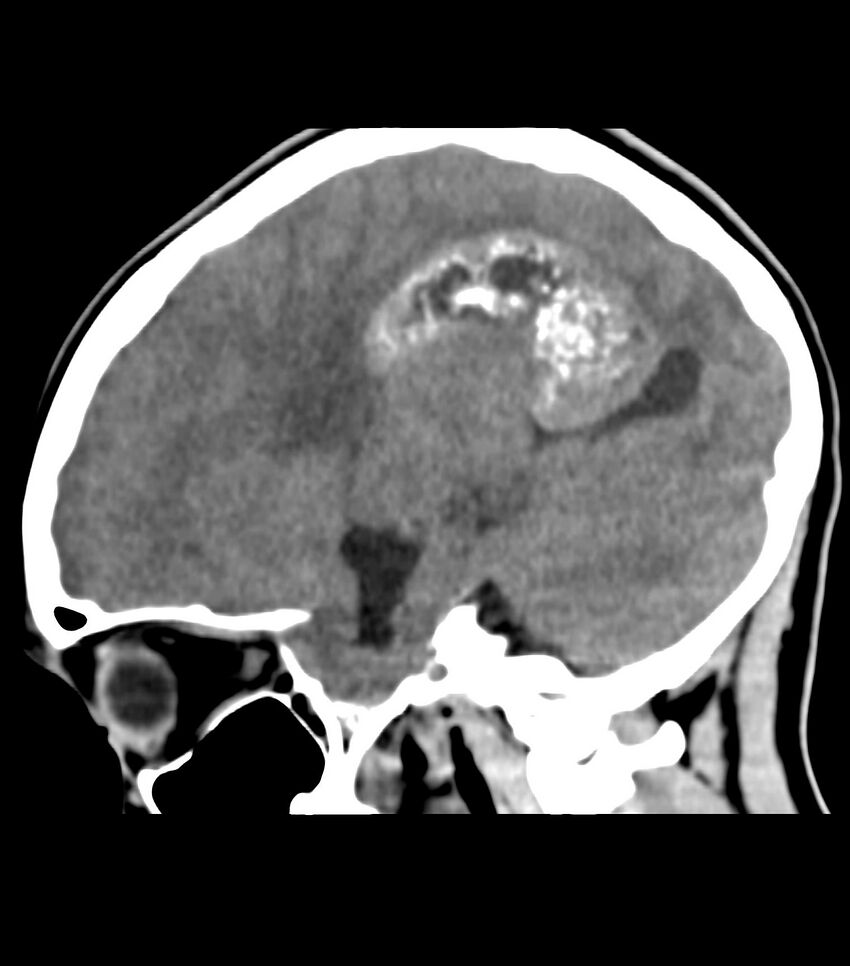 Choroid plexus carcinoma (Radiopaedia 91013-108552 B 47).jpg