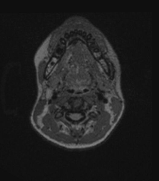 File:Choroid plexus carcinoma (Radiopaedia 91013-108553 Axial FLAIR C+ 29).jpg