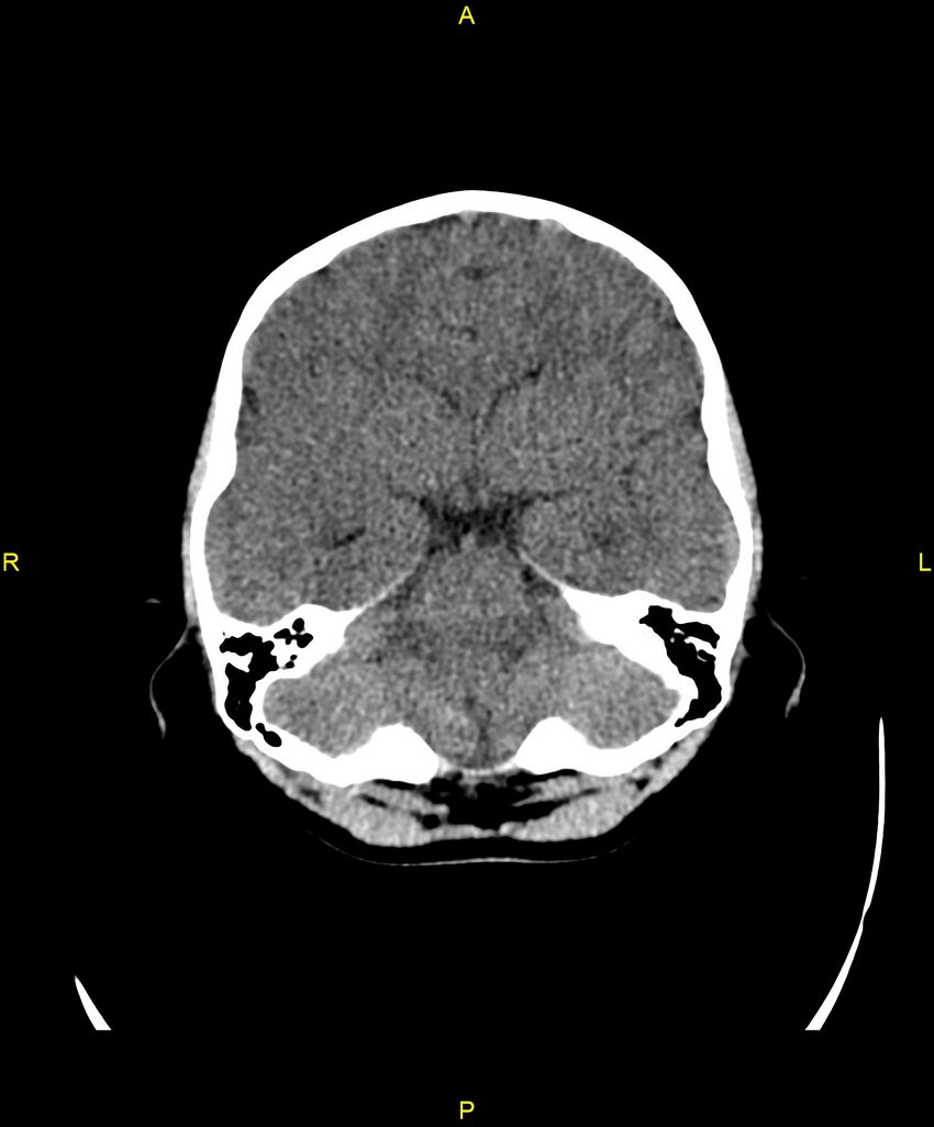 Choroidal fissure cyst (Radiopaedia 89481-106465 Axial non-contrast 45).jpg
