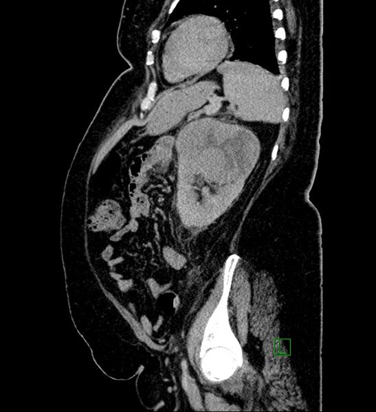 File:Chromophobe renal cell carcinoma (Radiopaedia 84239-99519 G 34).jpg