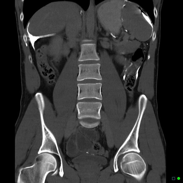 File:Chronic barium peritonitis and small bowel obstruction (Radiopaedia 29151-29548 B 1).jpg