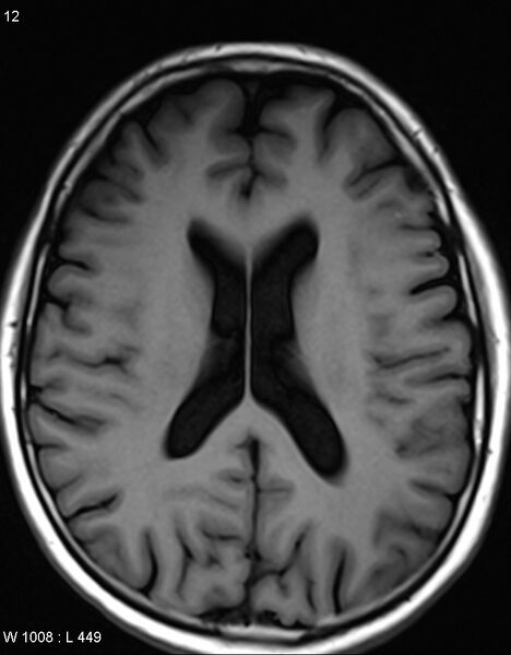 File:Chronic lymphocytic inflammation with pontine perivascular enhancement responsive to steroids (CLIPPERS) (Radiopaedia 37520-39374 Axial T1 11).jpg