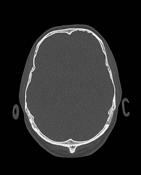 File:Chronic maxillary sinusitis caused by a foreign body (Radiopaedia 58521-65676 Axial bone window 326).jpg