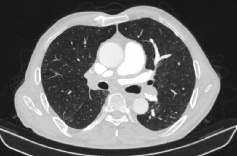 File:Chronic pulmonary embolism (Radiopaedia 91241-108843 Axial lung window 42).jpg