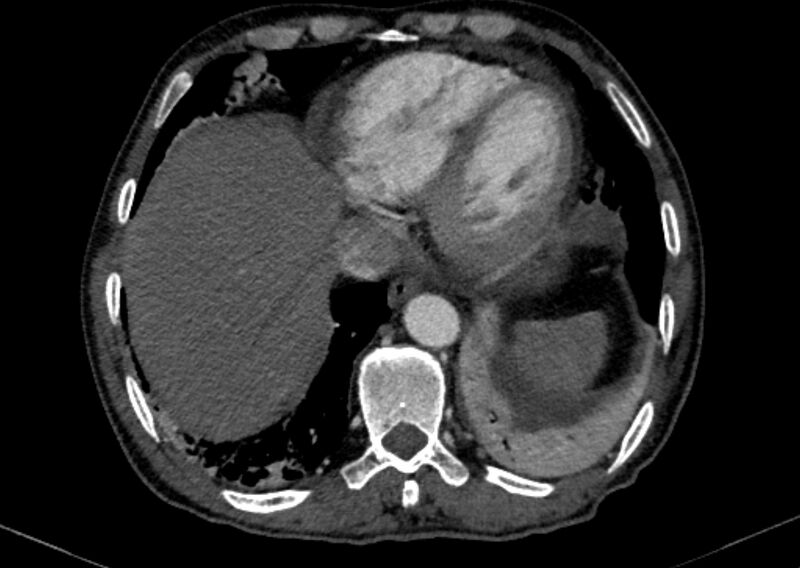 File:Chronic pulmonary embolism with bubbly consolidation (Radiopaedia 91248-108850 C+ arterial phase 121).jpg