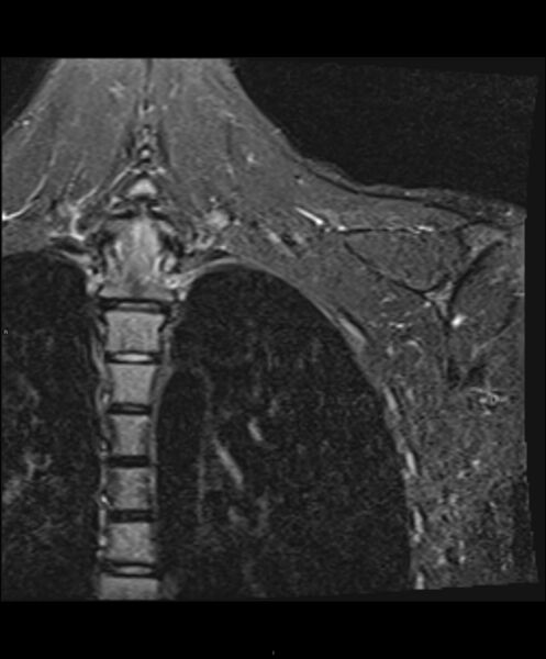 File:Chronic reactive multifocal osteomyelitis (CRMO) - clavicle (Radiopaedia 56406-63114 Coronal STIR 2).jpg