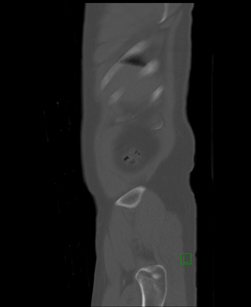 Clear cell renal cell carcinoma (Radiopaedia 85006-100539 Sagittal bone window 57).jpg