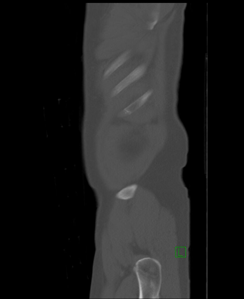 Clear cell renal cell carcinoma (Radiopaedia 85006-100539 Sagittal bone window 58).jpg