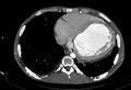 Coarctation of aorta with aortic valve stenosis (Radiopaedia 70463-80574 A 159).jpg